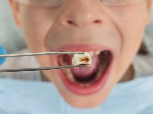 Best Broken Tooth Emergency  in Coal Grove, OH